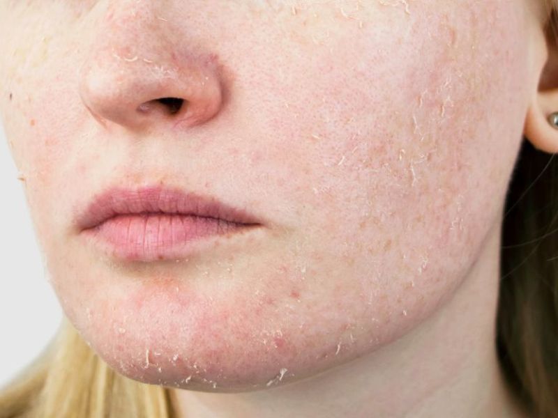 skin barrier
